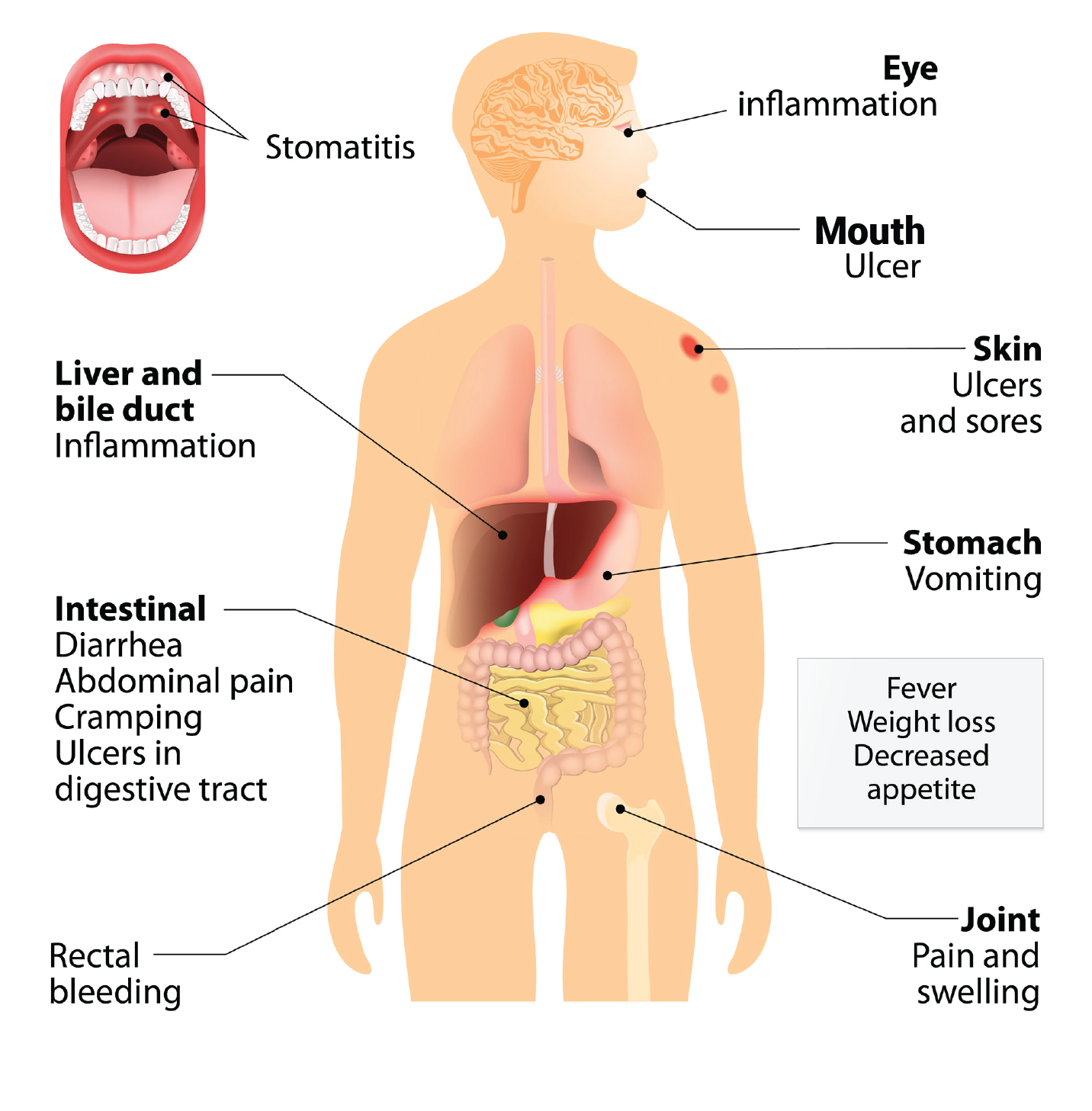 What is Crohn's Disease? Symptoms, Causes & Diagnosis