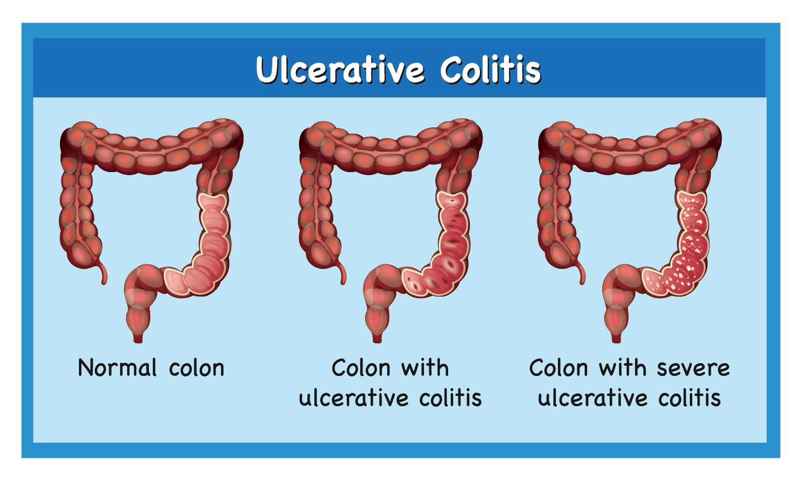 What is Ulcerative Colitis? Symptoms, Causes & Diagnosis